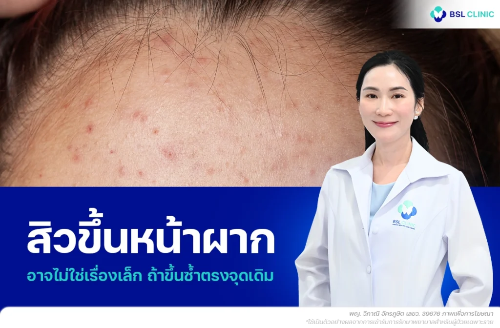 สิวขึ้นหน้าผาก เกิดจากอะไร? หรือจริง ๆ แล้วคือสิวอุดตันหน้าผากที่คุณมองข้าม