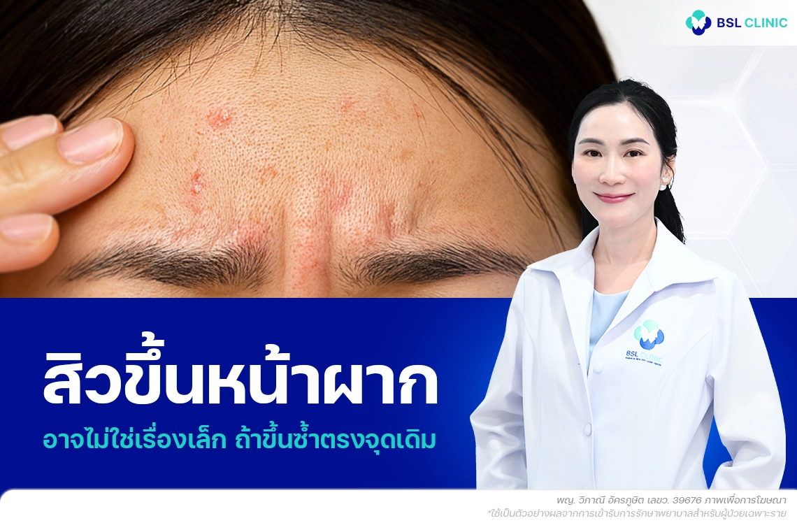 สิวขึ้นหน้าผาก