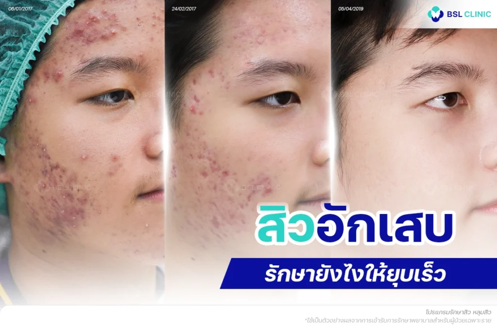 สิวอักเสบเป็นแบบไหน รู้จักสาเหตุและวิธีรักษาให้หายเร็ว