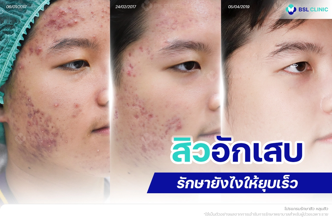 สิวอักเสบ