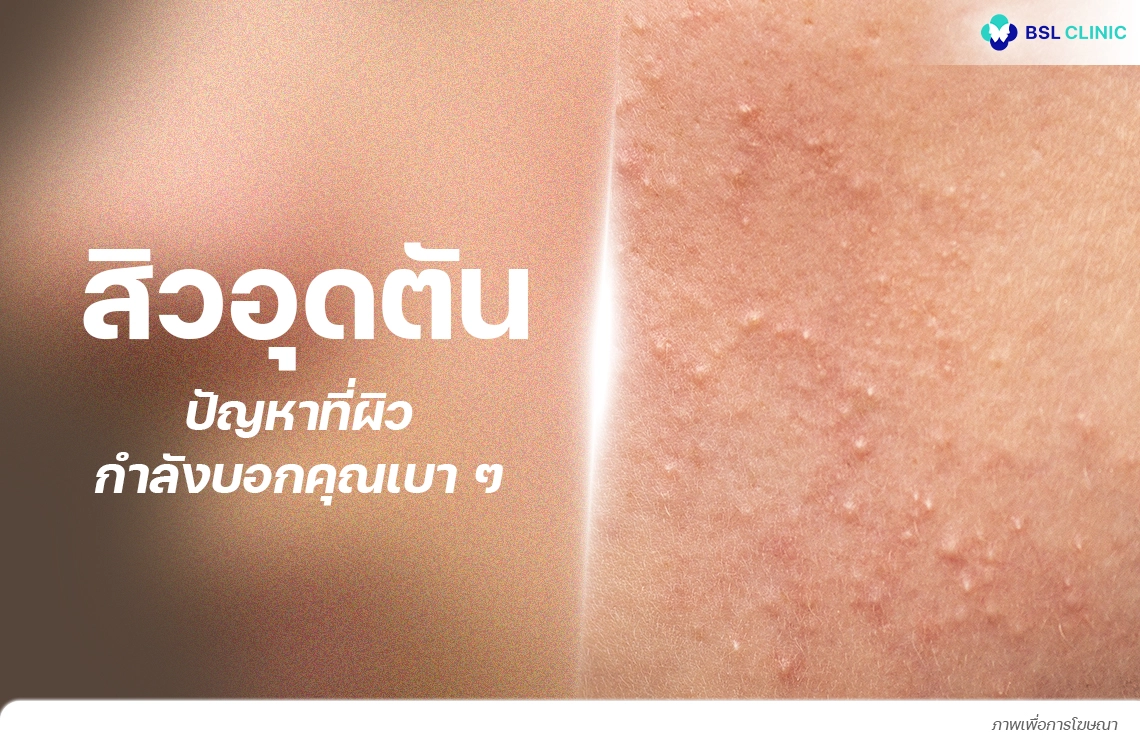 สิวอุดตัน รักษาสิวอุดตันกับแพทย์ bslclinic