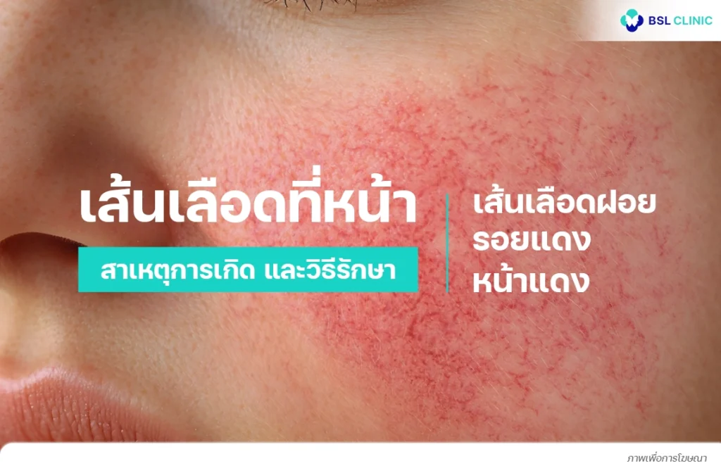 เส้นเลือดที่หน้าและเส้นเลือดฝอย เข้าใจต้นเหตุของหน้าแดง