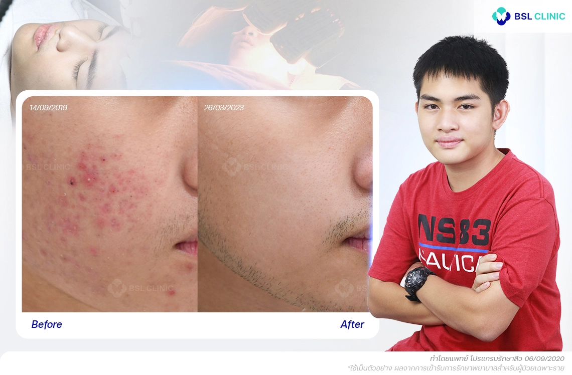 รีวิว สิวอักเสบไม่มีหัว