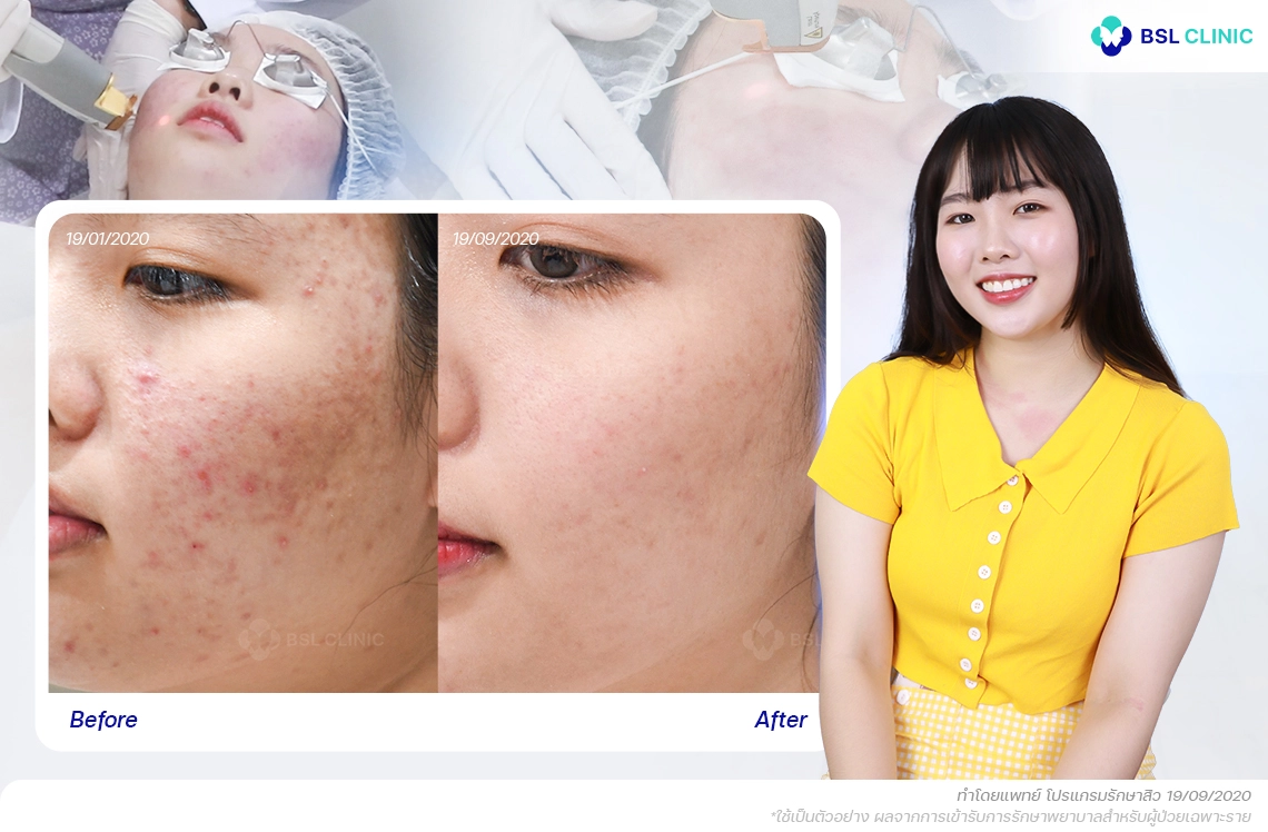 รีวิว สิวอักเสบไม่มีหัว