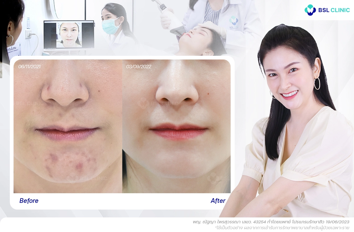 รีวิวรักษา สิวอักเสบ