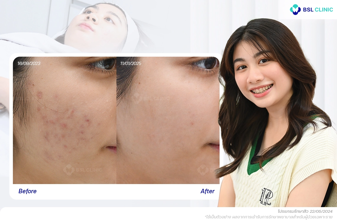 รีวิว สิวอักเสบไม่มีหัว