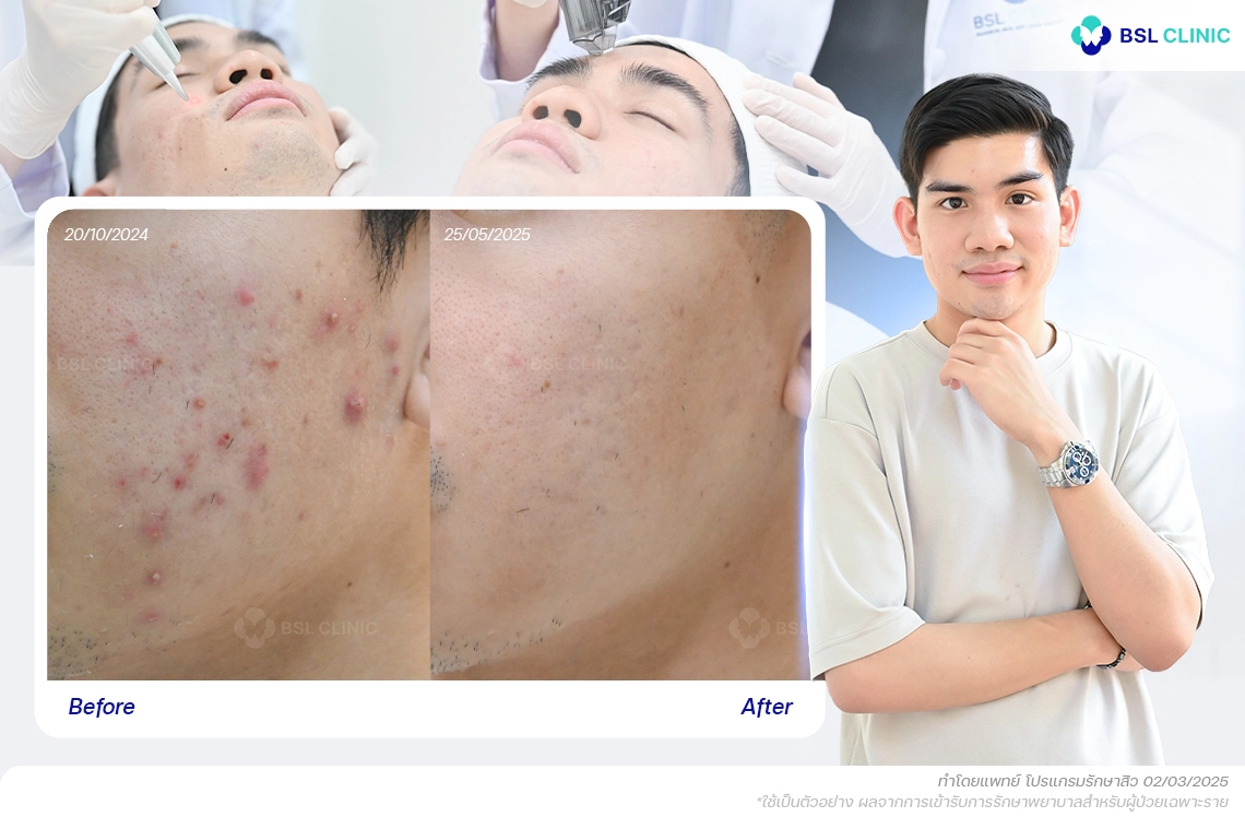 รีวิว สิวอักเสบ