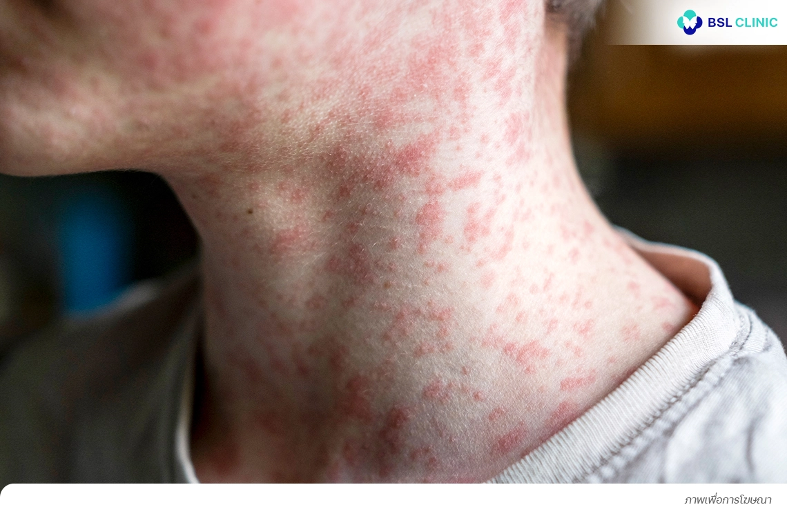 ผื่นจากการแพ้ยา Drug induced Dermatitis