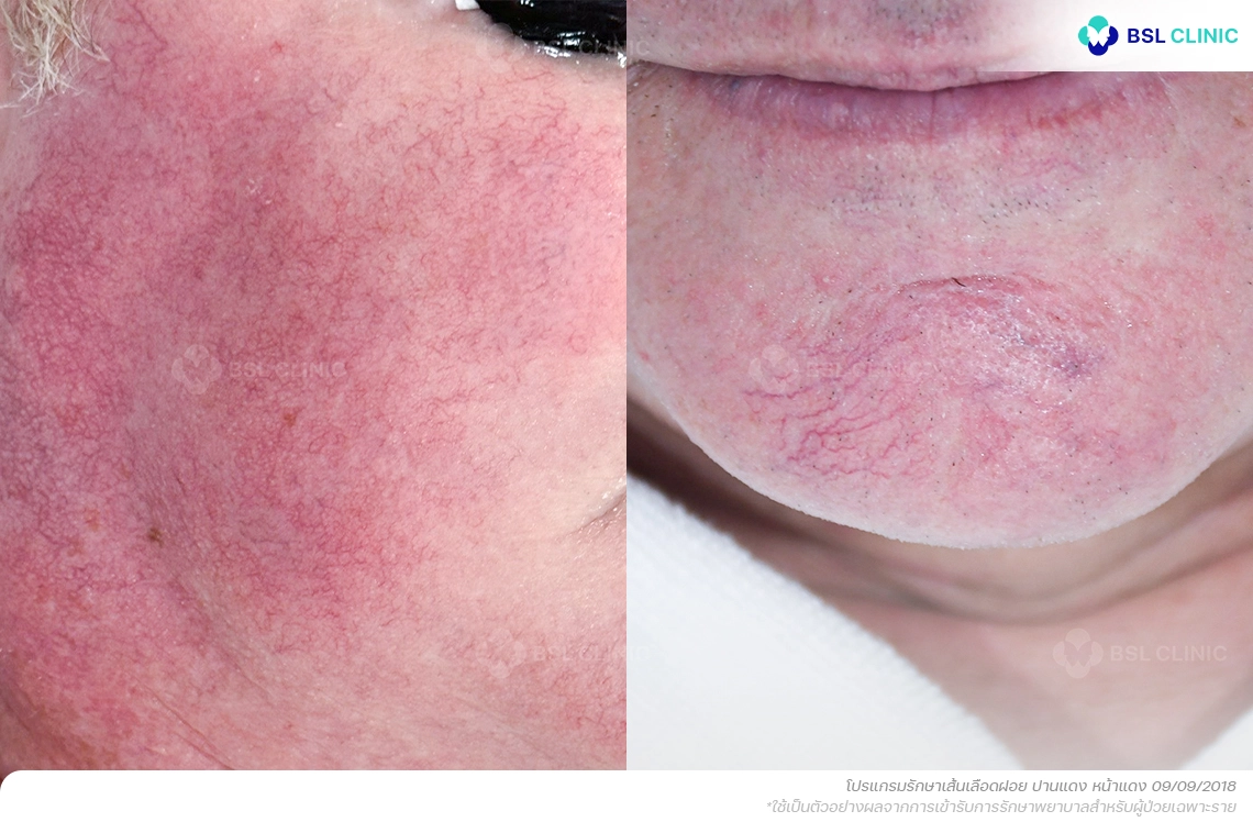 โรคโรซาเซีย Rosacea