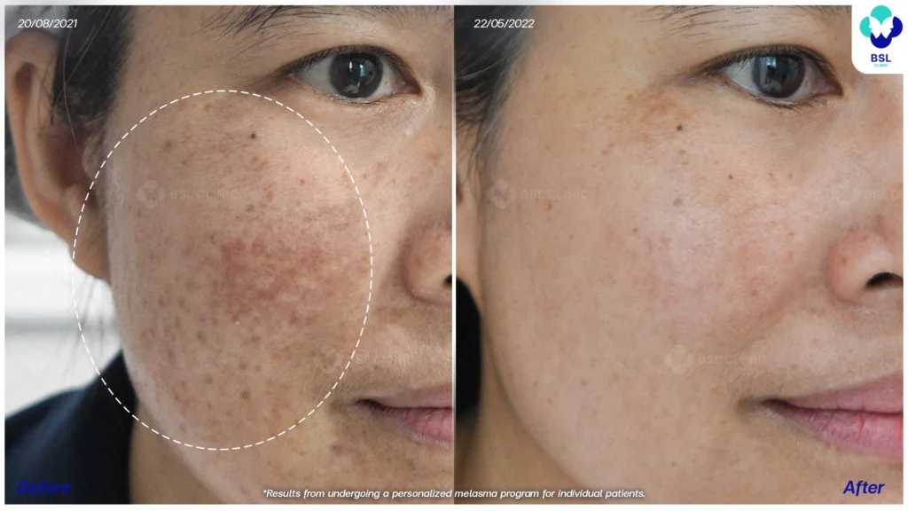 รีวิวรักษาฝ้า