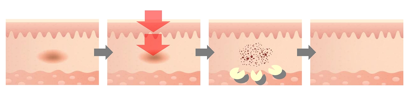 เลเซอร์ฝ้า Q-PTP Mode