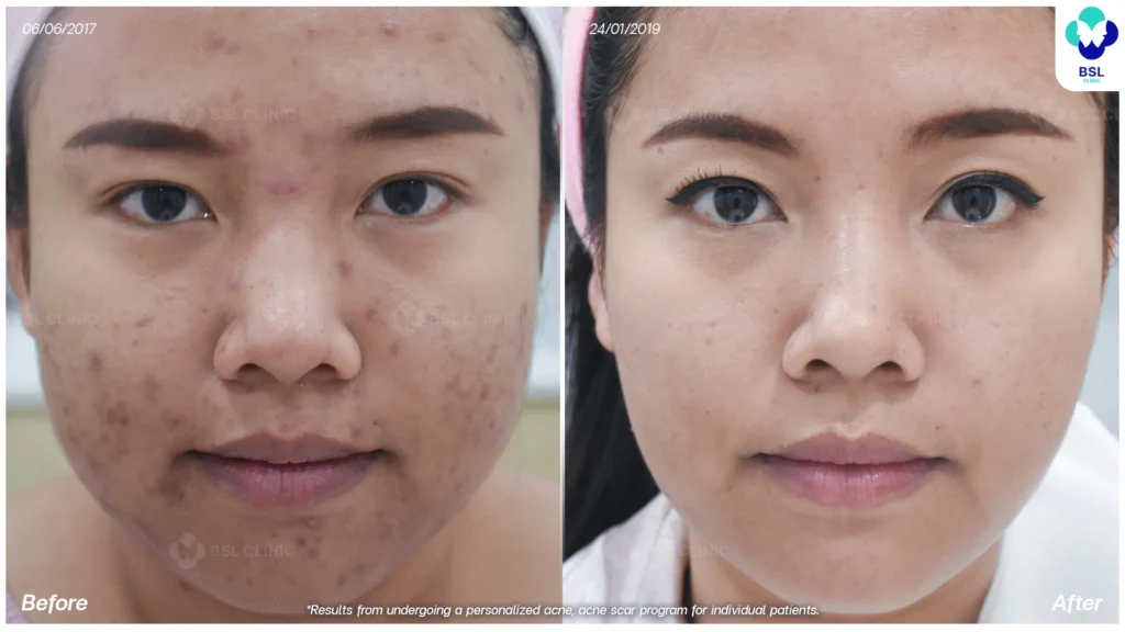 รีวิวรักษาสิว หน้าใสขึ้น