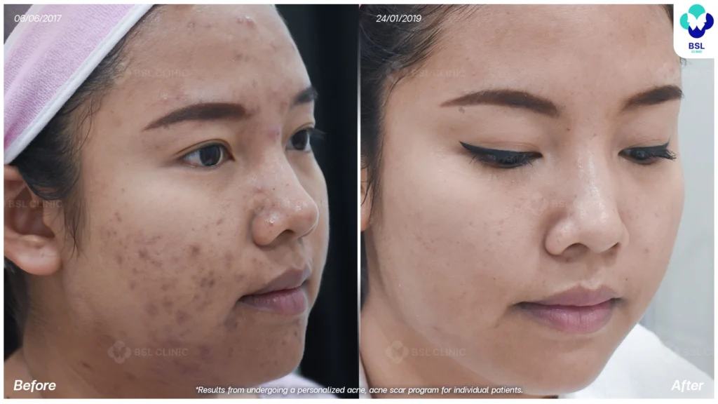 รีวิวรักษาสิว หน้าใสขึ้น