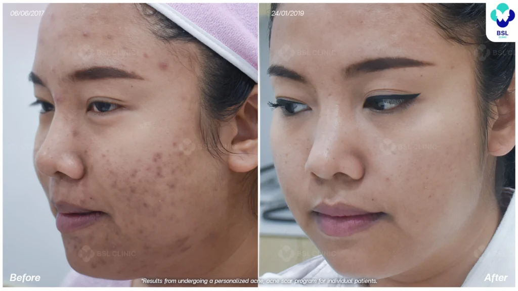 รีวิวรักษาสิว หน้าใสขึ้น