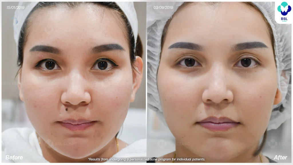 รักษาผิวแพ้ง่าย