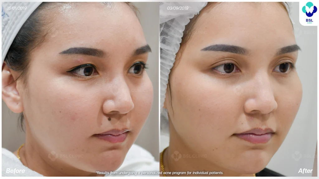 รักษาผิวแพ้ง่าย