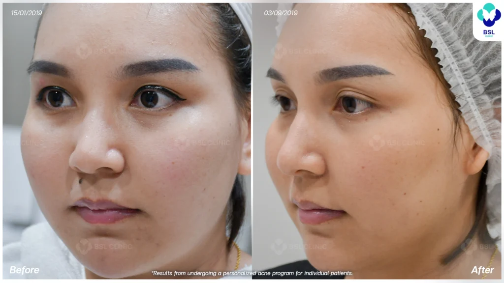 รักษาผิวแพ้ง่าย