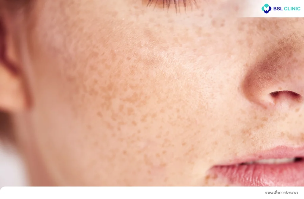 ฝ้าแดด ฝ้าฮอร์โมน ฝ้าเข้ม ฝ้าลึก ฝ้าเส้นเลือด