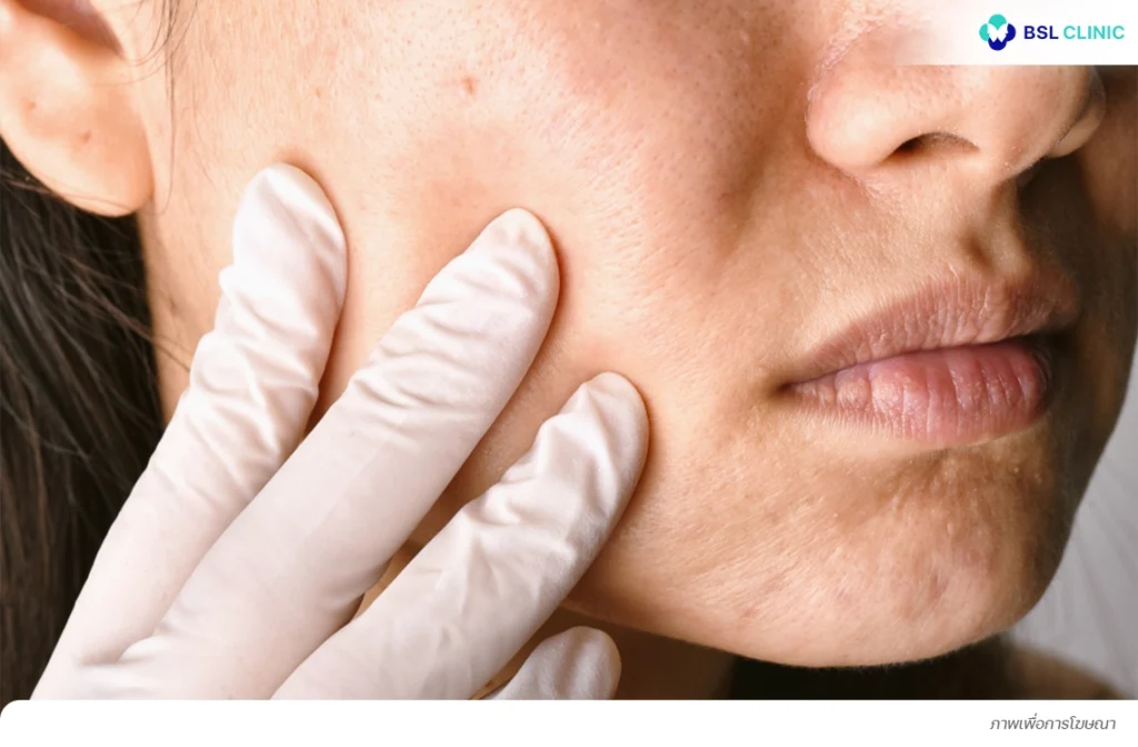 ผลข้างเคียงต่อผิว