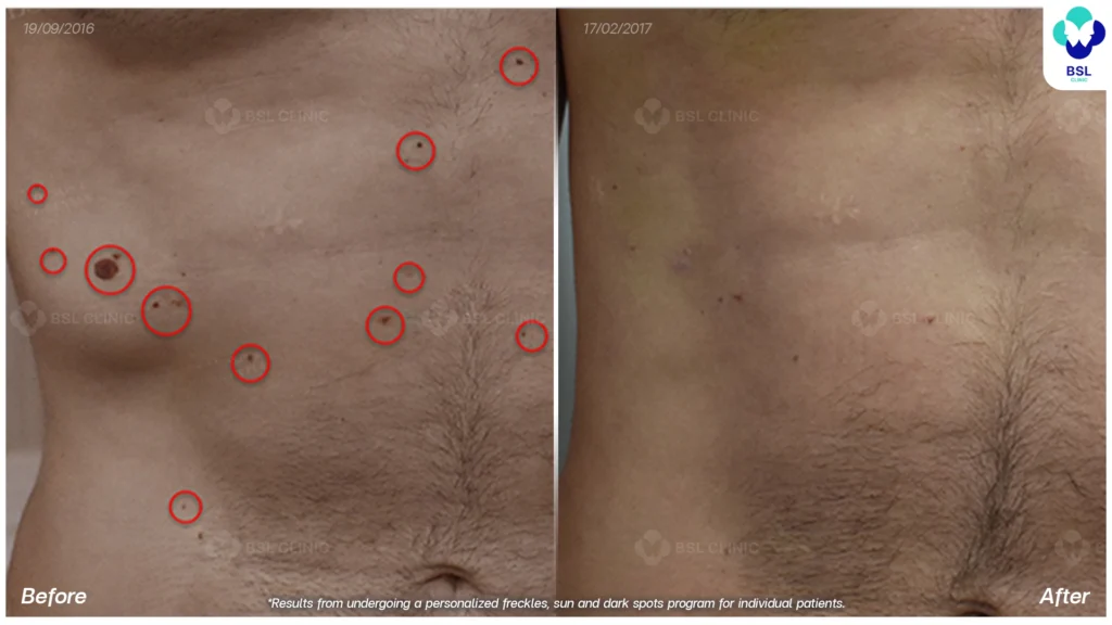 รีวิวรักษากระ