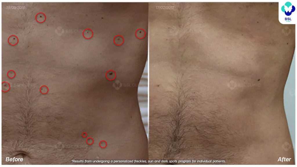 รีวิวรักษากระ