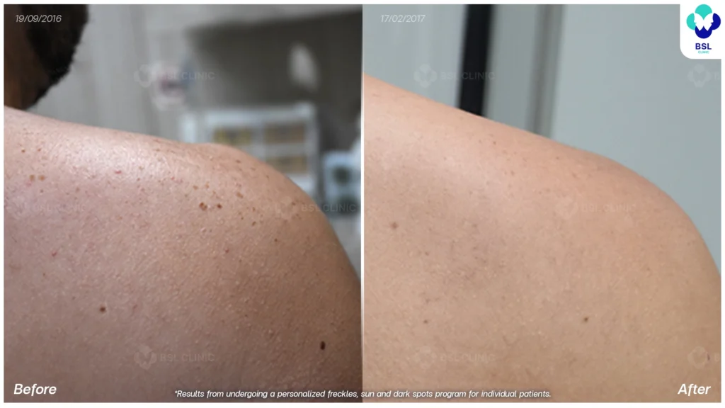 รีวิวรักษากระ