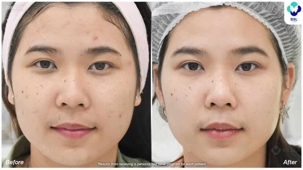 รีวิวรักษาสิวบนใบหน้า