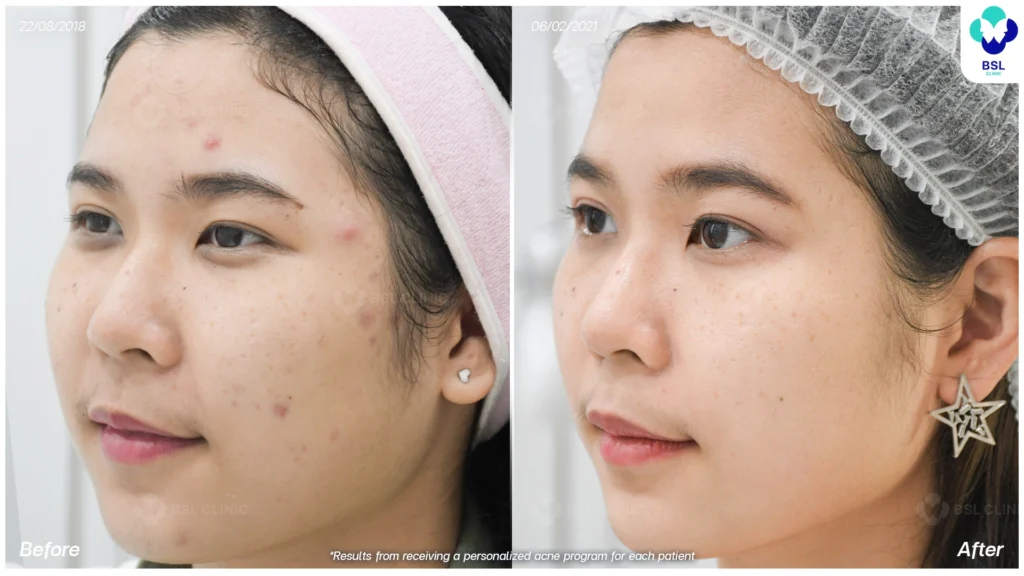 รีวิวรักษาสิวบนใบหน้า