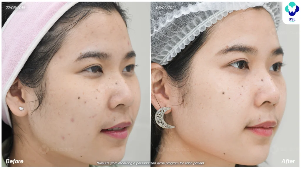 รีวิวรักษาสิวบนใบหน้า