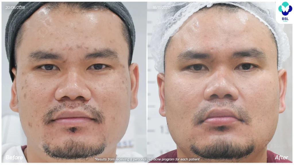 รีวิวรักษาสิว ผู้ชาย