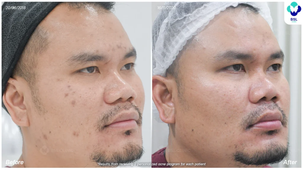 รีวิวรักษาสิว ผู้ชาย