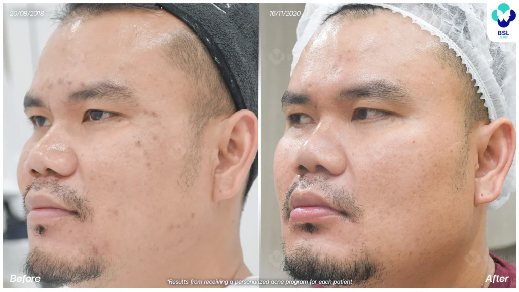 รีวิวรักษาสิว ผู้ชาย