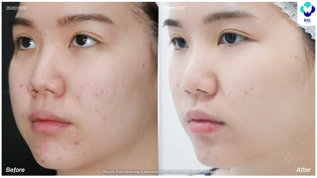 รีวิวรักษาสิว วัยรุ่น