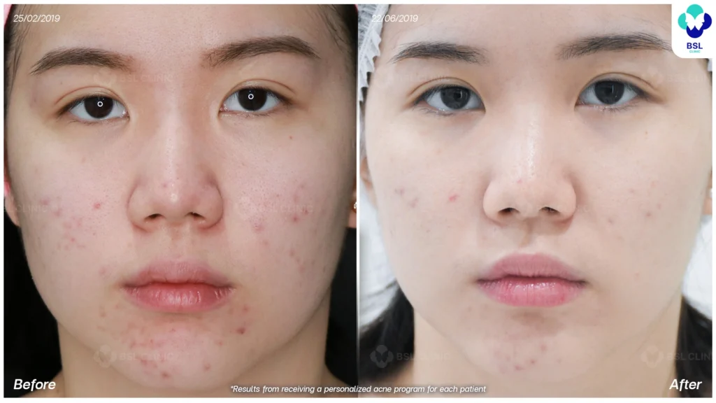 รีวิวรักษาสิว วัยรุ่น