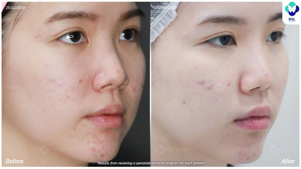 รีวิวรักษาสิว วัยรุ่น