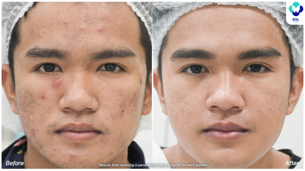 รีวิวรักษาสิว สิวอักเสบ