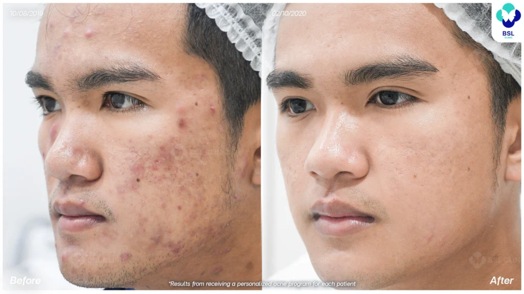 รีวิวรักษาสิว สิวอักเสบ