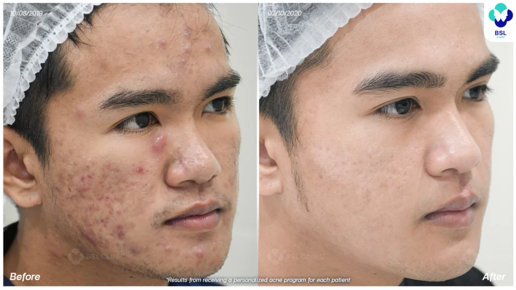 รีวิวรักษาสิว สิวอักเสบ