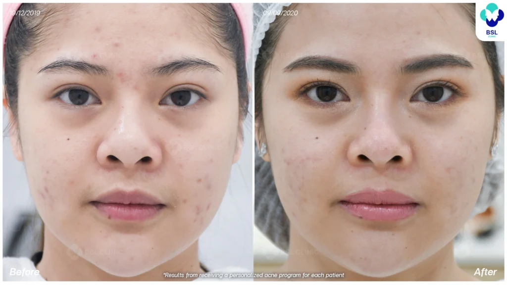 รีวิวรักษาสิว ผิวเรียบเนียน