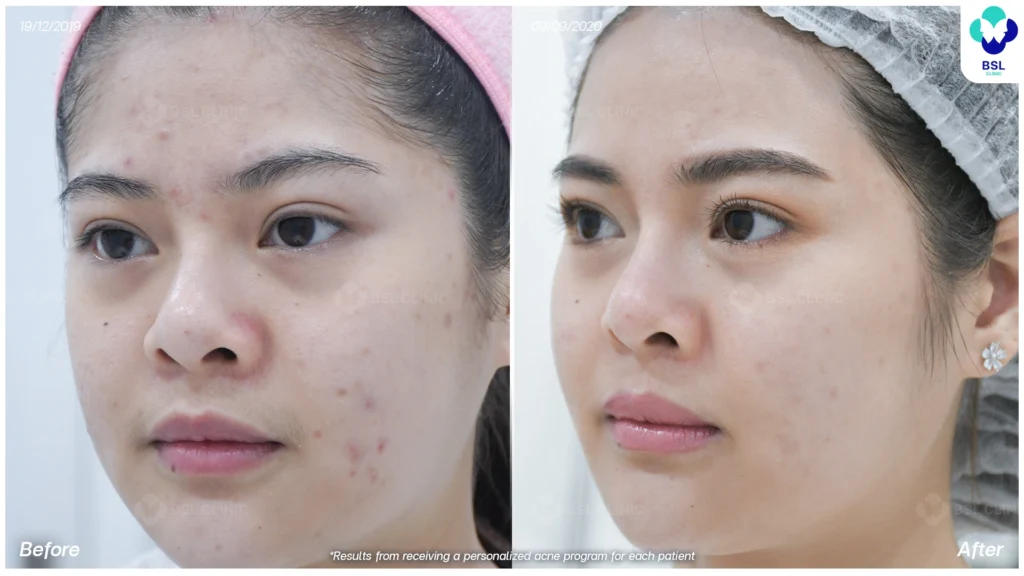 รีวิวรักษาสิว ผิวเรียบเนียน