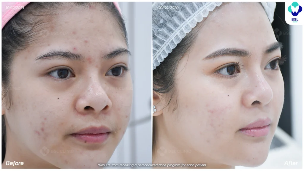 รีวิวรักษาสิว ผิวเรียบเนียน