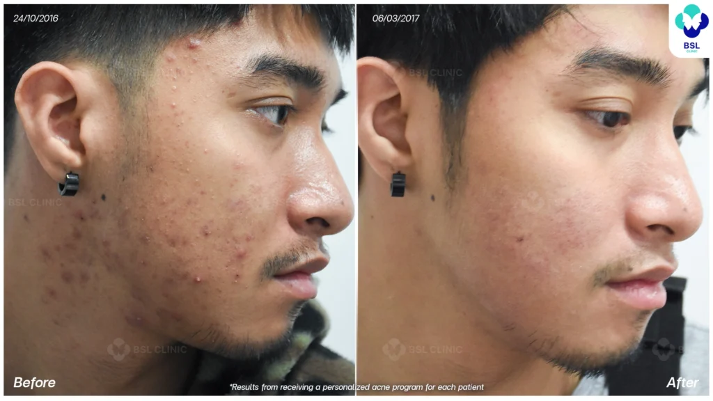 รีวิวรักษาสิว bsl clinic