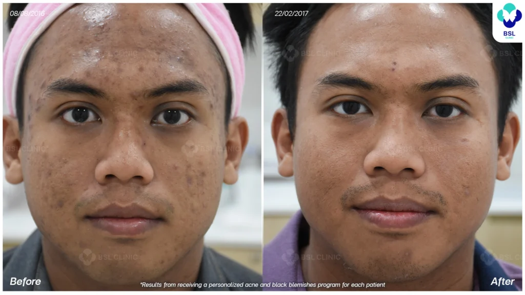 รีวิวรักษาสิว