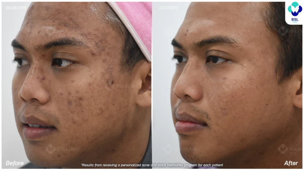 รีวิวรักษาสิว