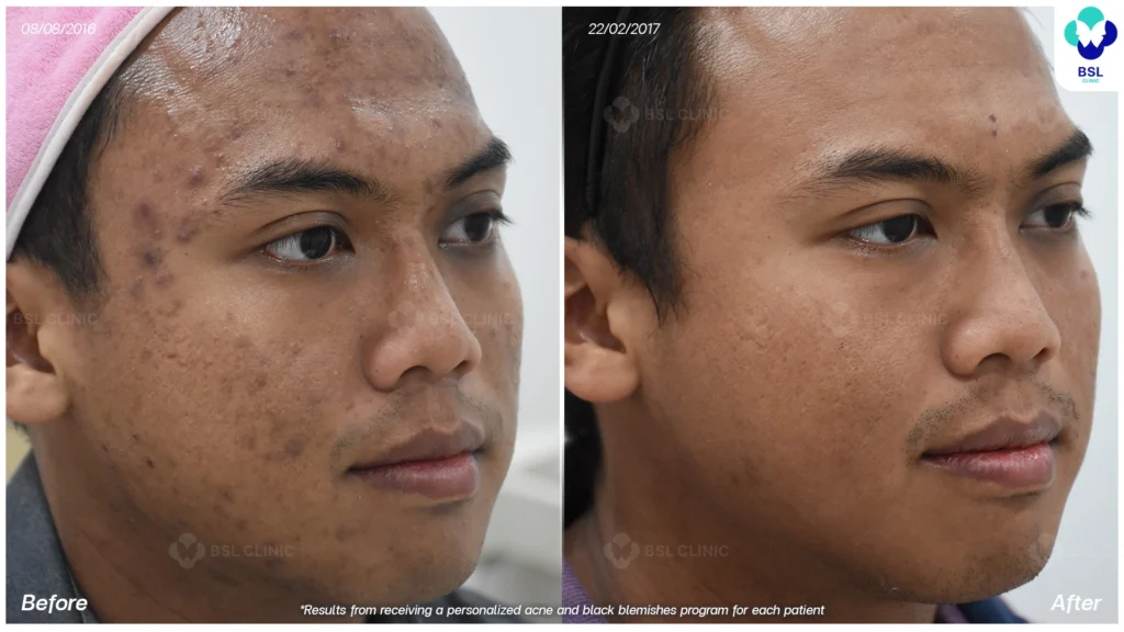 รีวิวรักษาสิว