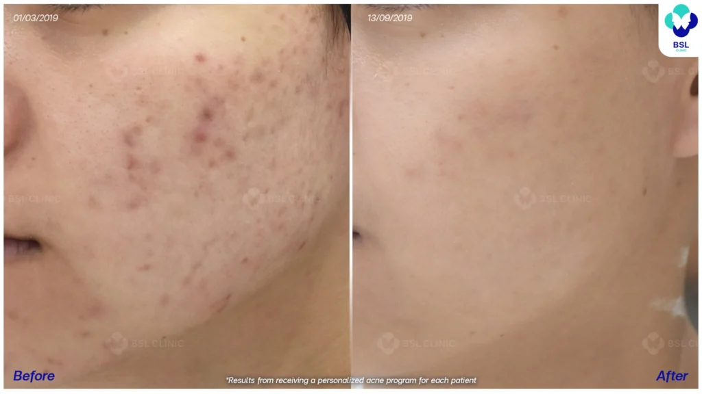 รีวิวรักษาสิว bsl clinic