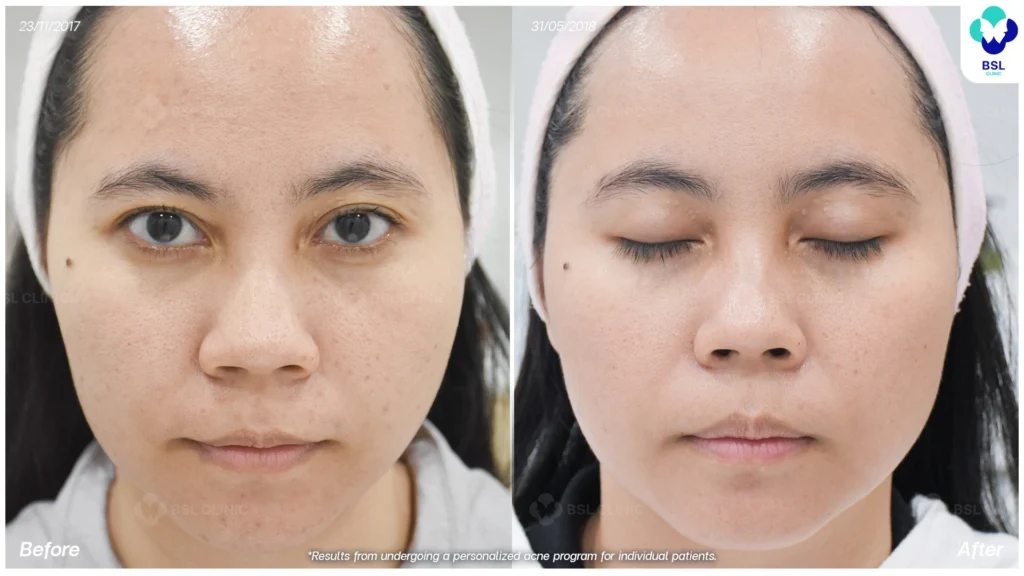 รักษาผิวแพ้ง่าย