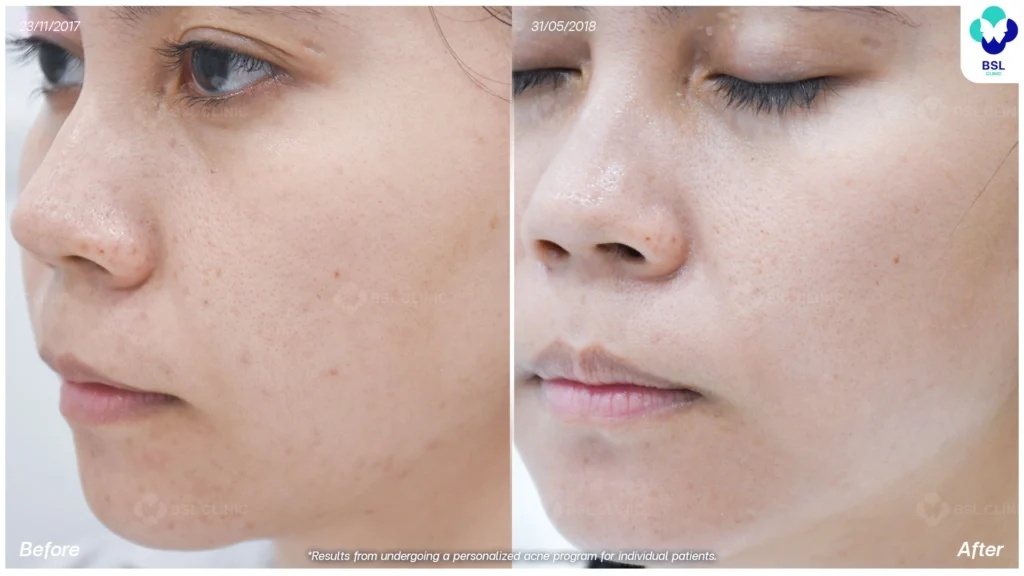 รักษาผิวแพ้ง่าย