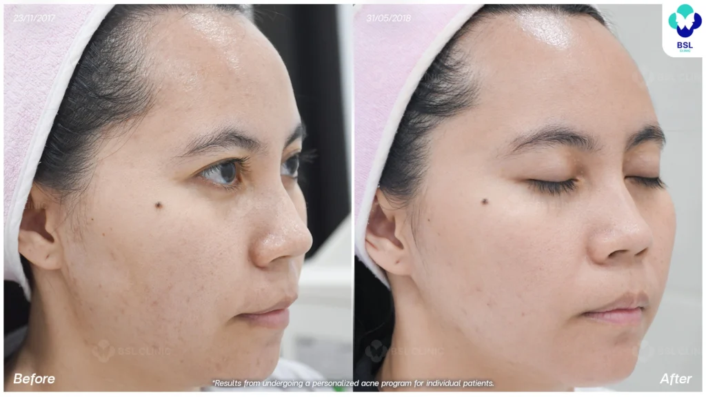 รักษาผิวแพ้ง่าย