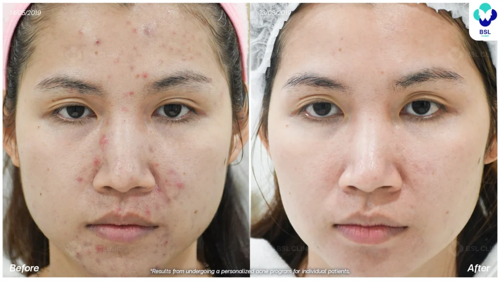 รีวิวรักษาสิว มั่นใจขึ้น